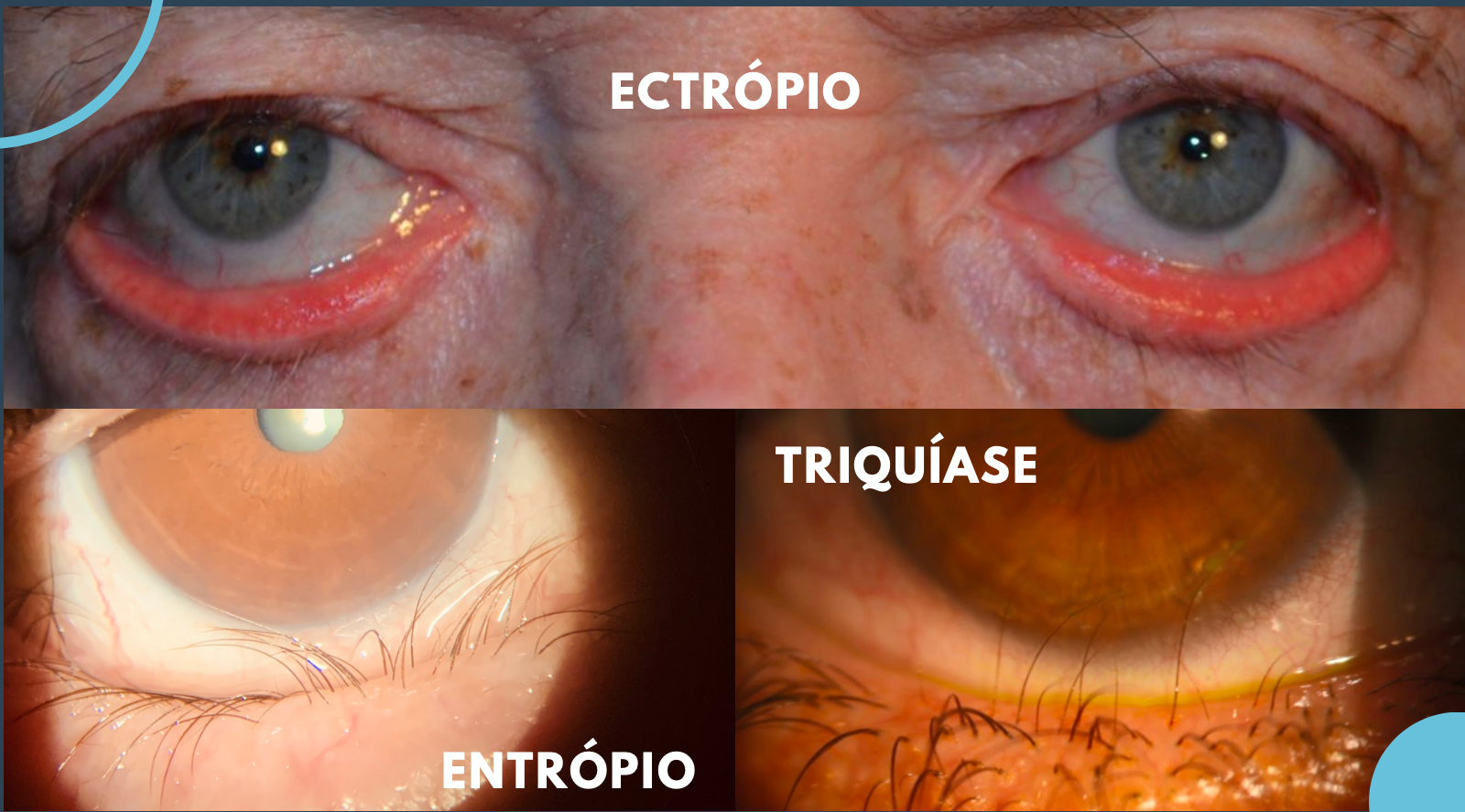 Cirurgia de pálpebra